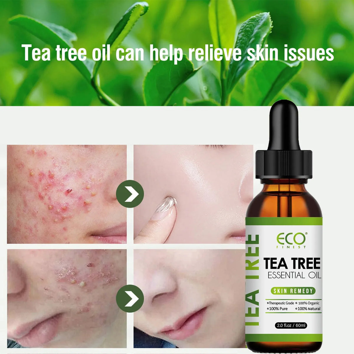 60ml glass bottle of pure tea tree essential oil for topical acne treatment and skin care.